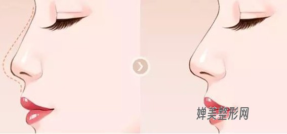 1681781309129837.jpg 玻尿酸隆鼻效果好不好?玻尿酸隆鼻有风险吗?