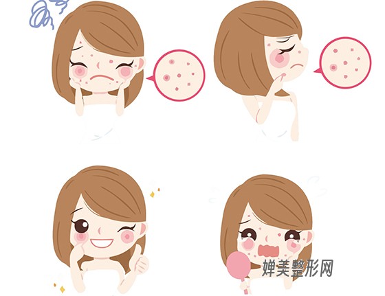 1681867299616199.jpg 激光祛痘有哪些优点?激光祛痘后怎么护理?