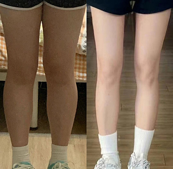 1681867744609002.jpeg 吸脂瘦小腿效果好不好?吸脂瘦小腿要注意哪些问题?