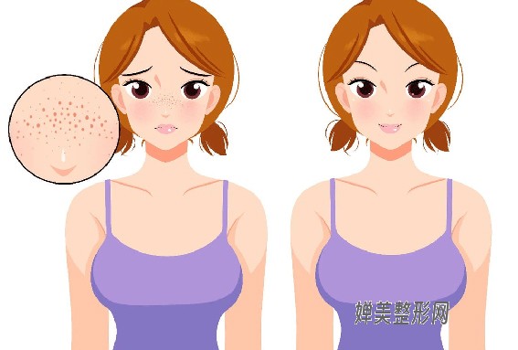 1681867876302431.jpg 激光祛雀斑效果好不好?激光祛雀斑会复发吗?