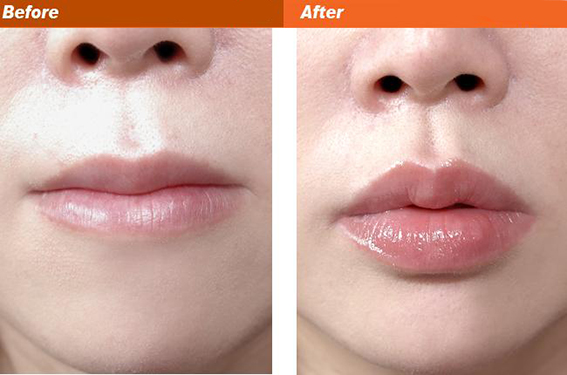 1681953960137883.jpeg 自体脂肪丰唇有哪些优势?自体脂肪丰唇有副作用吗?
