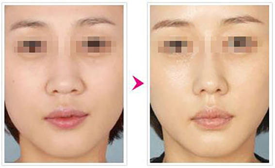 1681954094126262.jpeg 缩鼻翼的方法有哪些?鼻翼缩小术效果好不好?