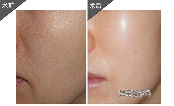 1681954355121198.jpg 光子嫩肤效果怎么样?光子嫩肤后要注意哪些问题?