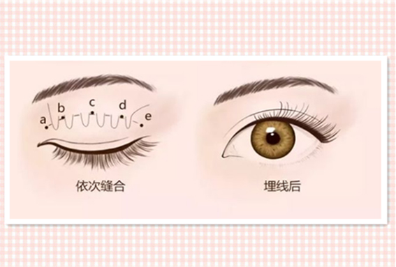 1681954484916354.jpeg 埋线双眼皮效果好不好?埋线双眼皮后怎么护理?