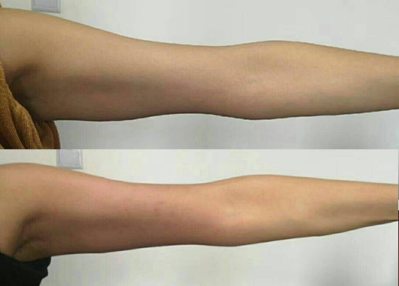 1682040089842640.jpeg 吸脂瘦手臂效果好不好?吸脂瘦手臂后要注意哪些问题?