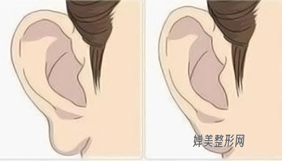 1682040204807740.jpg 丰耳垂的方法有哪些?丰耳垂要注意哪些问题?