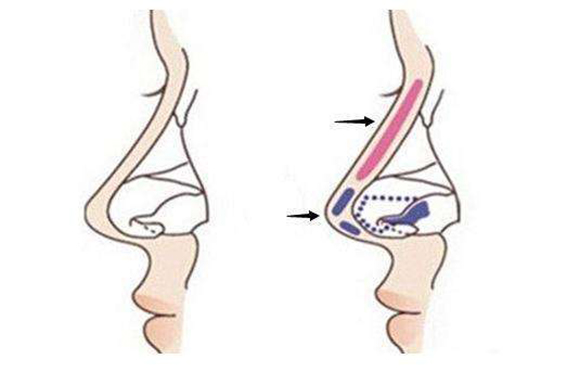 1682040478856226.jpeg 隆鼻的方法有哪些?自体软骨隆鼻有哪些优点?