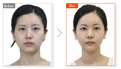 眼部为什么会出现眼袋？