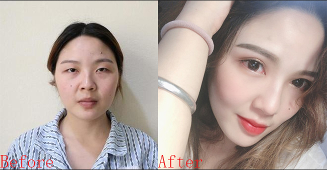 苏州美贝尔陈光双眼皮案例 苏州美贝尔医院是三甲医院吗?正规吗口碑怎么样附上案例_价格表