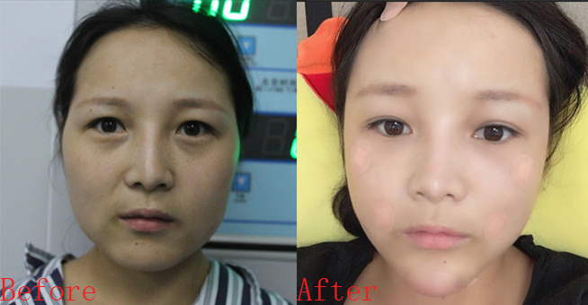 苏州美贝尔聂志宏案例 苏州美贝尔医院是三甲医院吗?正规吗口碑怎么样附上案例_价格表