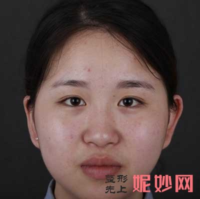 在中日友好医院找薛志强做了鼻综合,术后半年效果变化很大