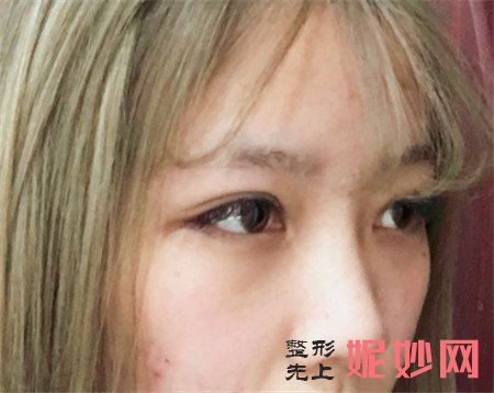 到北京英煌医疗美容诊所找王勋做鼻部多项怎么样？真人案例对比图分享