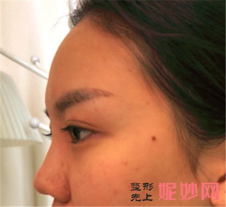 在北京韩啸找姜辉做的耳软骨复合隆鼻，术后120天鼻子恢复得很好