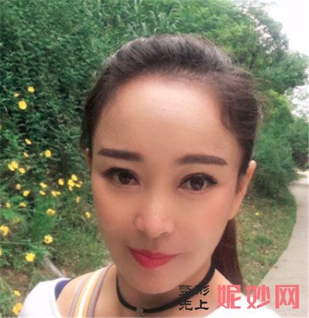 到北京加减美找黄寅守医生做的埋线提升，术后120天脸型和气质都改变了