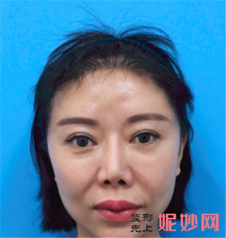 在北京彤美找潘彦龙医生做的埋线提升,术后90天脸“嘭”起来了