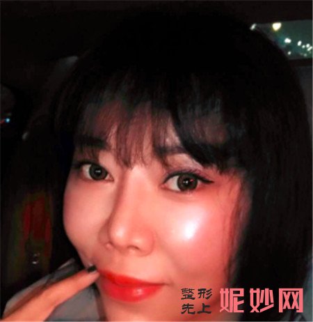 在北京彤美找潘彦龙医生做的埋线提升,术后90天脸“嘭”起来了