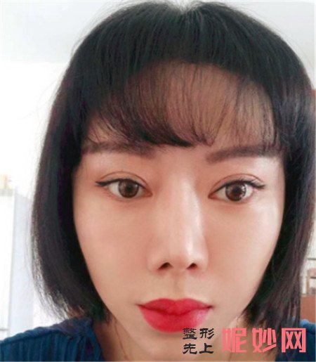 在北京彤美找潘彦龙医生做的埋线提升,术后90天脸“嘭”起来了