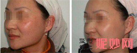 浙江省人民医院整形外科吴美华怎么样?光子祛斑案例及出诊时间简介