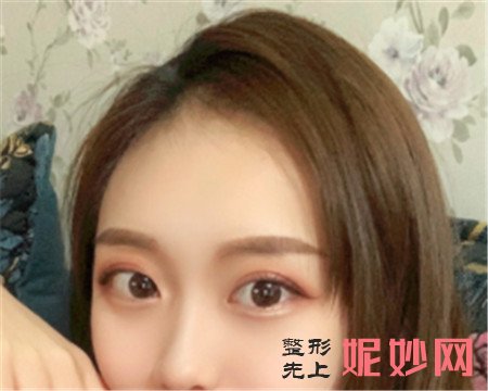 山东省立医院整形科霍然医生做的肋软骨隆鼻,拥有了令人羡慕的小翘鼻!