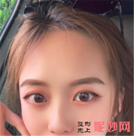 山东省立医院整形科霍然医生做的肋软骨隆鼻,拥有了令人羡慕的小翘鼻!