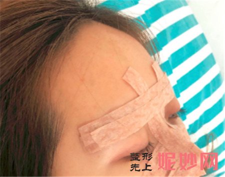 山东省立医院整形科霍然医生做的肋软骨隆鼻,拥有了令人羡慕的小翘鼻!