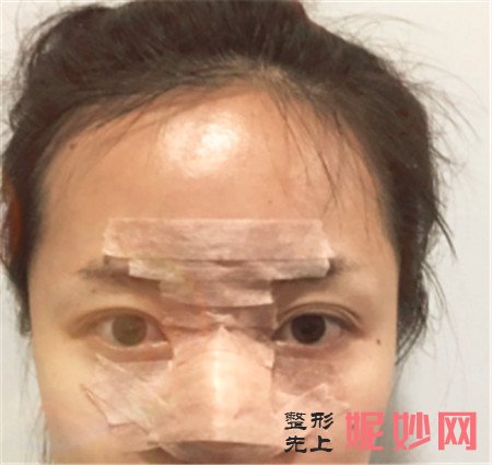 到湘雅二医院整形科找贺吉庸做的肋软骨隆鼻怎么样?真人案例分享