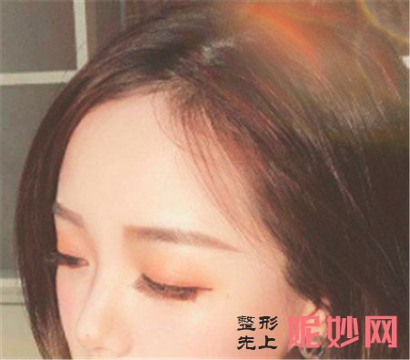 到湘雅二医院整形科找贺吉庸做的肋软骨隆鼻怎么样?真人案例分享