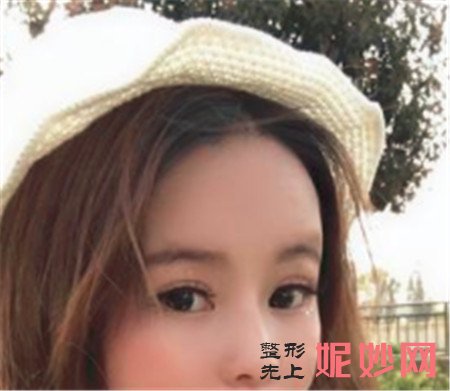 在湘雅二医院整形科找赵柏程做的肋软骨隆鼻,变漂亮后越来越自信!