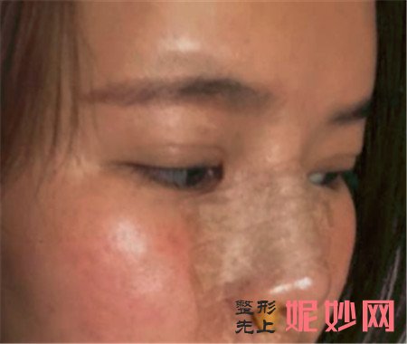 在湘雅二医院整形科找赵柏程做的肋软骨隆鼻,变漂亮后越来越自信!