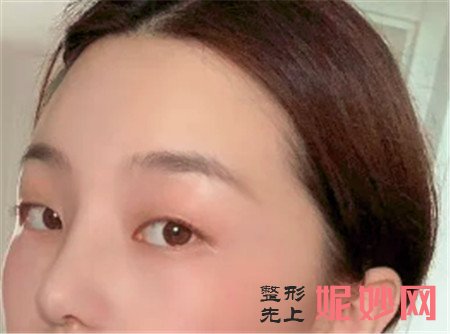 谢谢湘雅二医院整形科的王玉银给我做的鼻综合手术,弧度非常的自然!