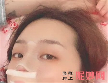 谢谢湘雅二医院整形科的王玉银给我做的鼻综合手术,弧度非常的自然!