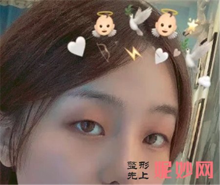 谢谢湘雅二医院整形科的王玉银给我做的鼻综合手术,弧度非常的自然!