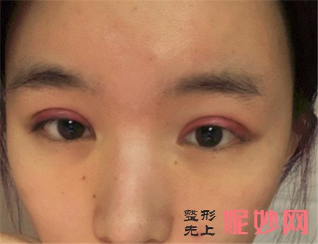 在湘雅二医院整形科找鲁青医生做的眼综合怎么样?案例效果图展示