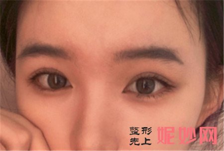 在湘雅二医院整形科找鲁青医生做的眼综合怎么样?案例效果图展示