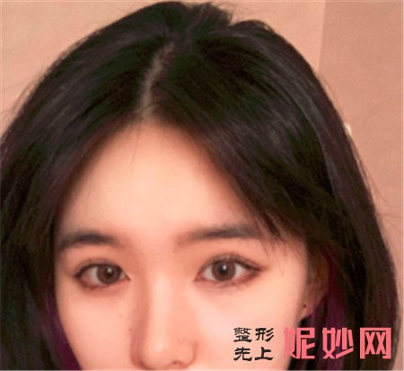 在湘雅二医院整形科找鲁青医生做的眼综合怎么样?案例效果图展示