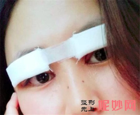 感谢湘雅二医院整形科李晓芳医生给我做的双眼皮,眼睛变大了不止一倍