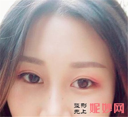 感谢湘雅二医院整形科李晓芳医生给我做的双眼皮,眼睛变大了不止一倍