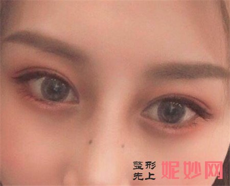 感谢湘雅二医院整形科李晓芳医生给我做的双眼皮,眼睛变大了不止一倍