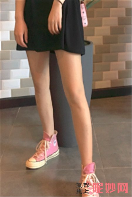 在湘雅三医院烧伤整形科找李萍做的大腿吸脂,腿细了穿什么都好看