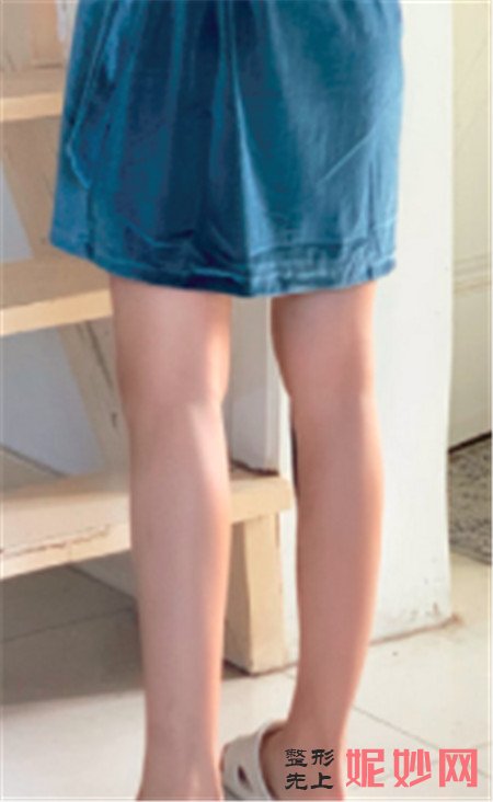 在湘雅三医院烧伤整形科找李萍做的大腿吸脂,腿细了穿什么都好看