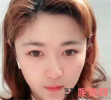 到湘雅三医院烧伤整形外科找尹朝奇做的埋线提升,术后满满少女感