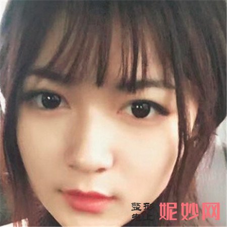 到湘雅三医院烧伤整形外科找尹朝奇做的埋线提升,术后满满少女感