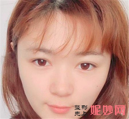 到湘雅三医院烧伤整形外科找尹朝奇做的埋线提升,术后满满少女感