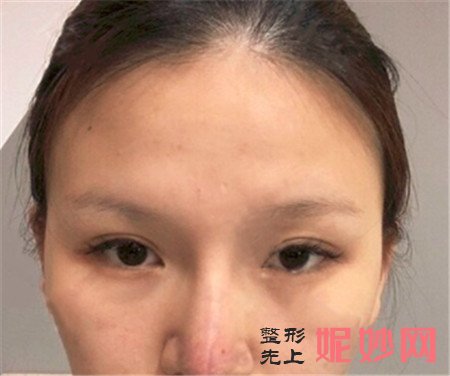 湘雅三医院烧伤整形科找王少华做的肋软骨隆鼻,不用羡慕别人的高鼻梁