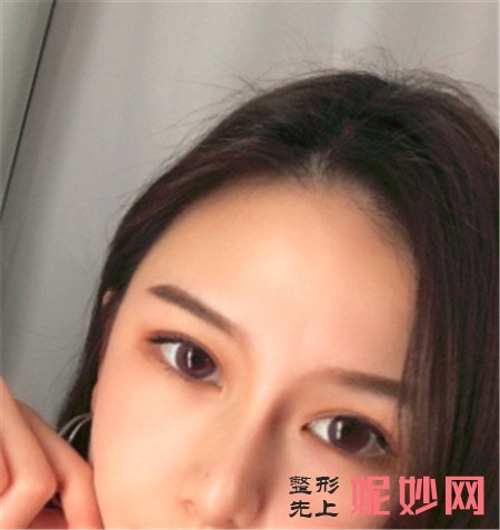 湘雅三医院烧伤整形科找王少华做的肋软骨隆鼻,不用羡慕别人的高鼻梁