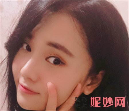 感谢成都铜雀台的周柯医生给我做的鼻综合,跟我理想中的鼻子一模一样