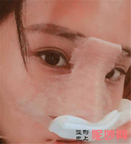 感谢成都铜雀台的周柯医生给我做的鼻综合,跟我理想中的鼻子一模一样