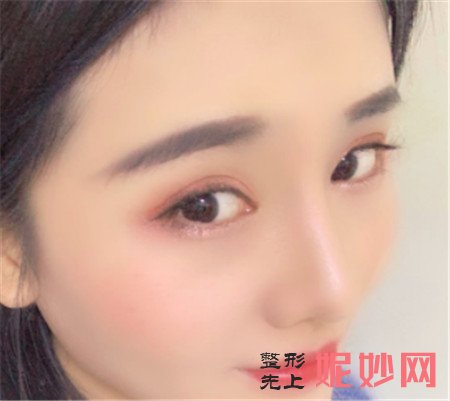 感谢成都铜雀台的周柯医生给我做的鼻综合,跟我理想中的鼻子一模一样