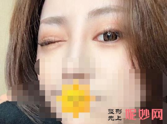 上海首尔丽格医疗美容医院怎么样?医院介绍,副双眼皮修复案例及价格表!
