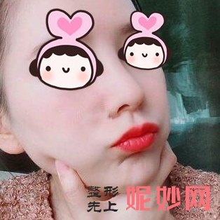 上海港华医院吕金陵医生技术怎么样?附隆鼻案例分析以及价格表。